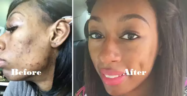 Photos: See How My Boyfriends S.p3rm Cleared My Pimples